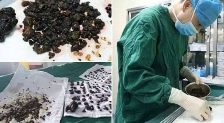 9 hihetetlen dolog, amit orvosok operáltak ki emberekből! Ez kiveri a biztosítékot! Hihetetlen dolgok az emberekben, amiket orvosok operáltak ki