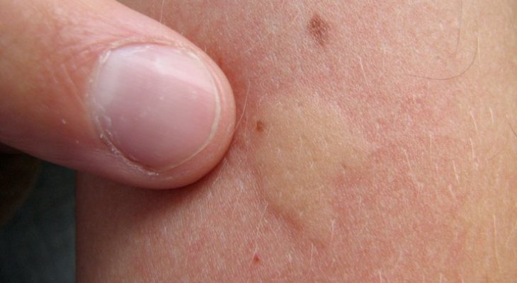 Szúnyogcsípés ellen természetes módszerrel